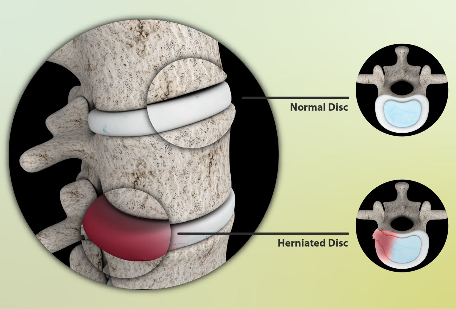 What Is A Herniated Disk In The Lower Back