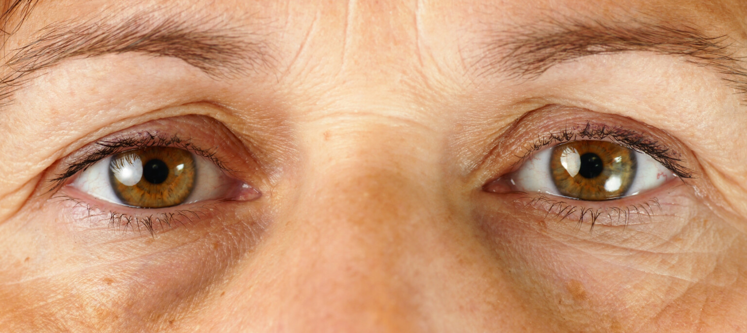 Under-Eye Wrinkles: Have Surgery; TCA Peel Won’t Work » Scary Symptoms