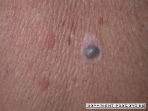 How Common Is a Blue Melanoma? — Scary Symptoms