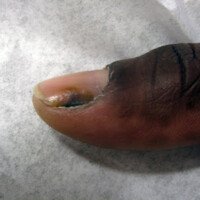 Melanoma in Fingernails: Blacks Not Immune to Skin Cancer
