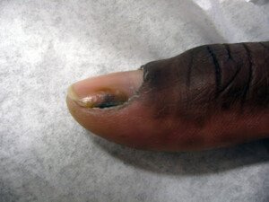 Melanoma In Fingernails Blacks Not Immune To Skin Cancer Scary Symptoms