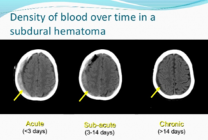 subdural hematoma