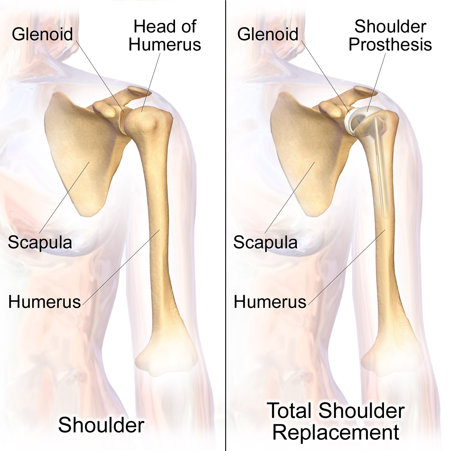 Shoulder Replacement Surgery Results in Old vs. Young Patients