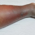 Can a Blood Clot in the Leg Break off with Movement?