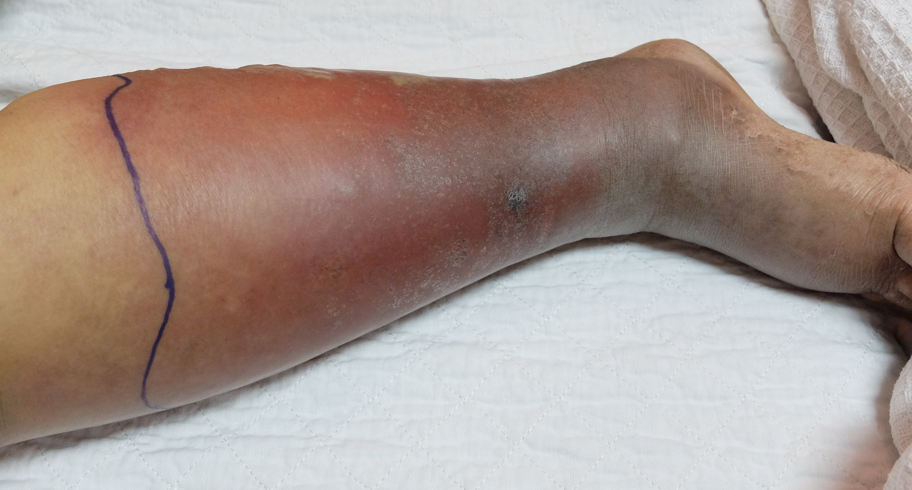 The Two Leading Causes of Chronic Venous Insufficiency?