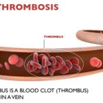 When Are IVC Filters Used for Pulmonary Embolus Prevention?