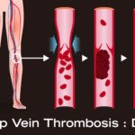 Number of DVTs Missed by Ultrasound