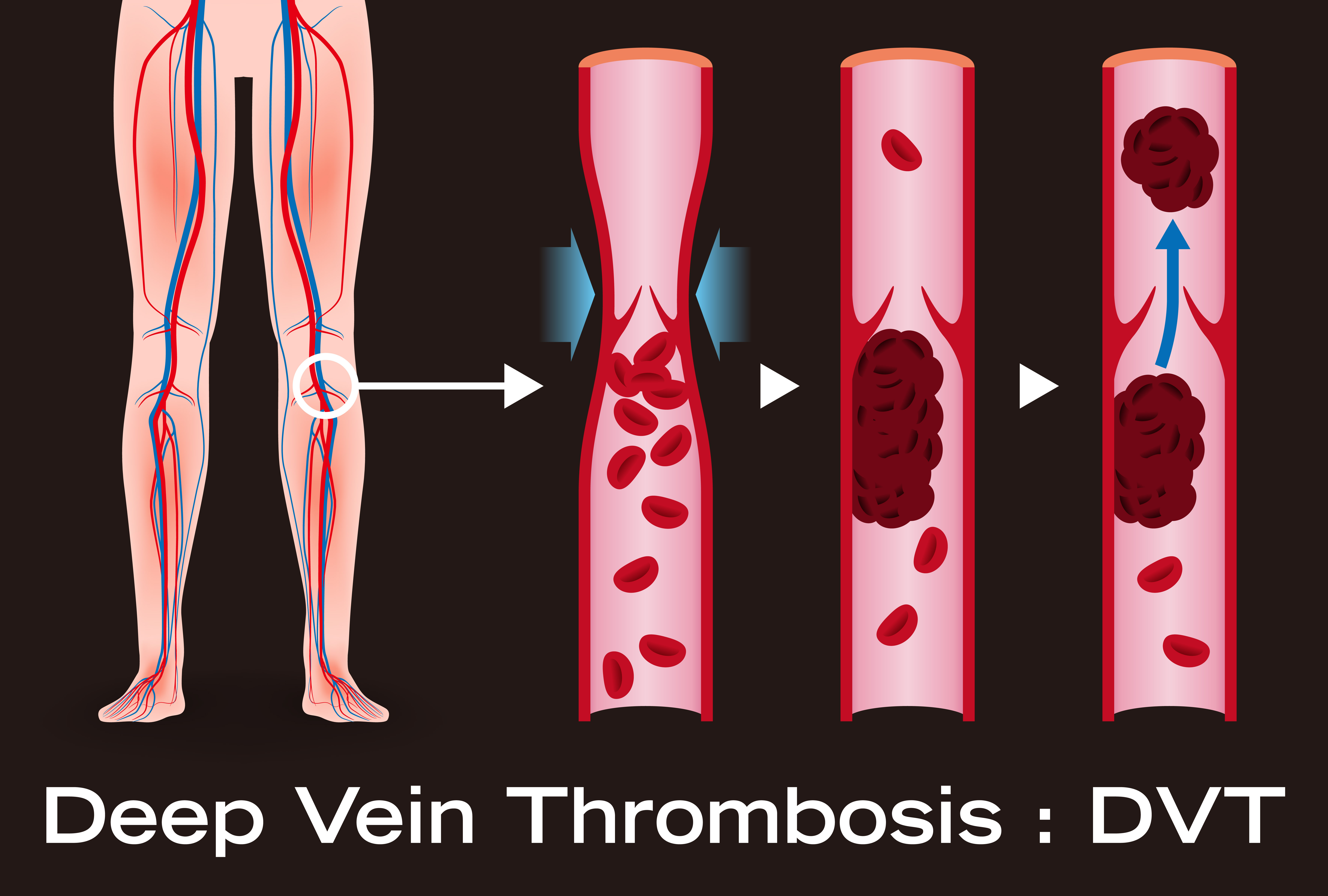 Causes of DVT in Absence of Risk Factors & Clotting Disorder