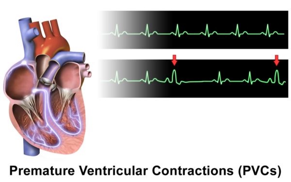 PVCs: Frequency Per Minute, Hour, Day, Dangers » Scary Symptoms