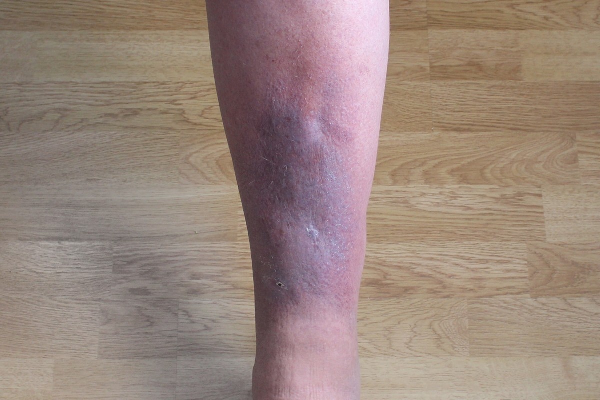 Aspirin vs. Heparin for Preventing Blood Clots » Scary Symptoms