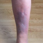 How Long After Air Travel Does DVT (Blood Clot) Risk Last?