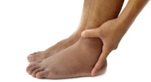 Can a DVT Cause Swelling in the Ankle Only & Nowhere Else?