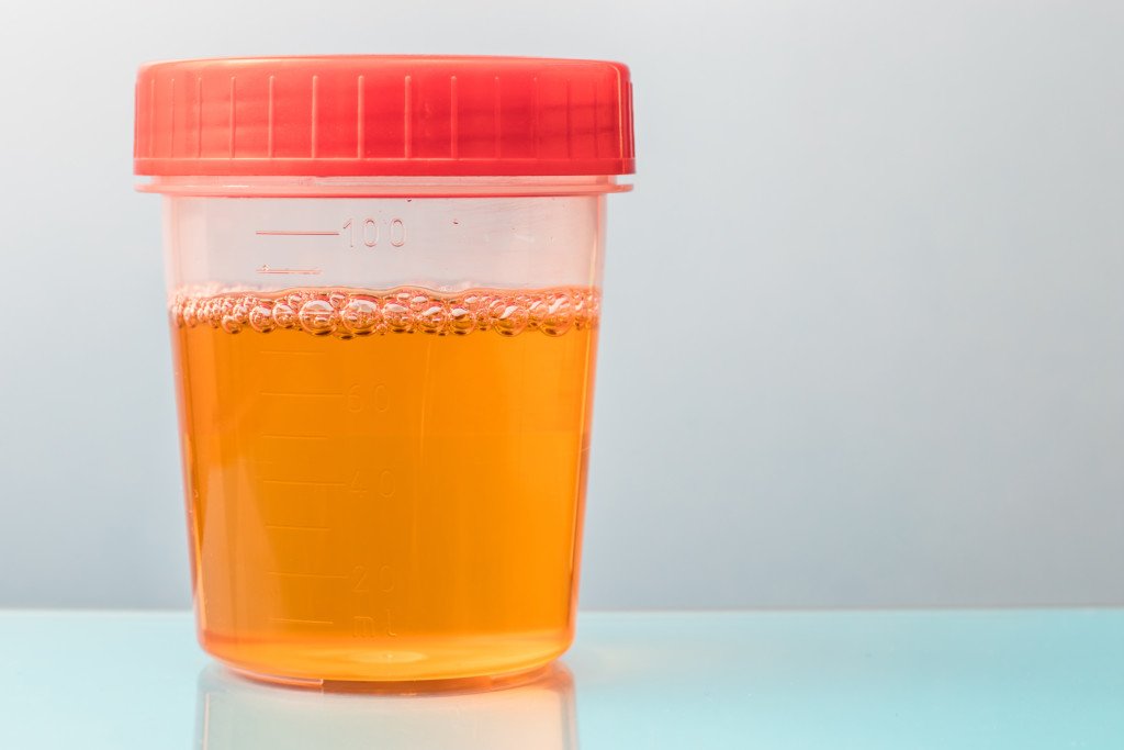 Causes of Orange Urine  Can One Be Cancer  Scary Symptoms
