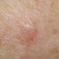 How Common Is a Flesh Colored Melanoma? » Scary Symptoms