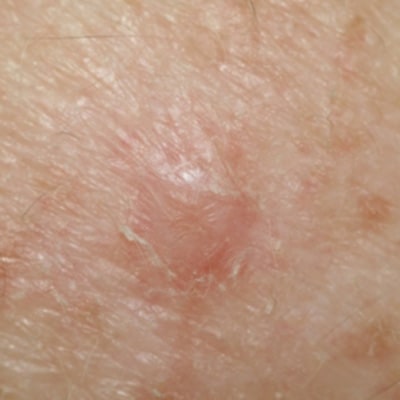 How Common Is a Flesh Colored Melanoma?