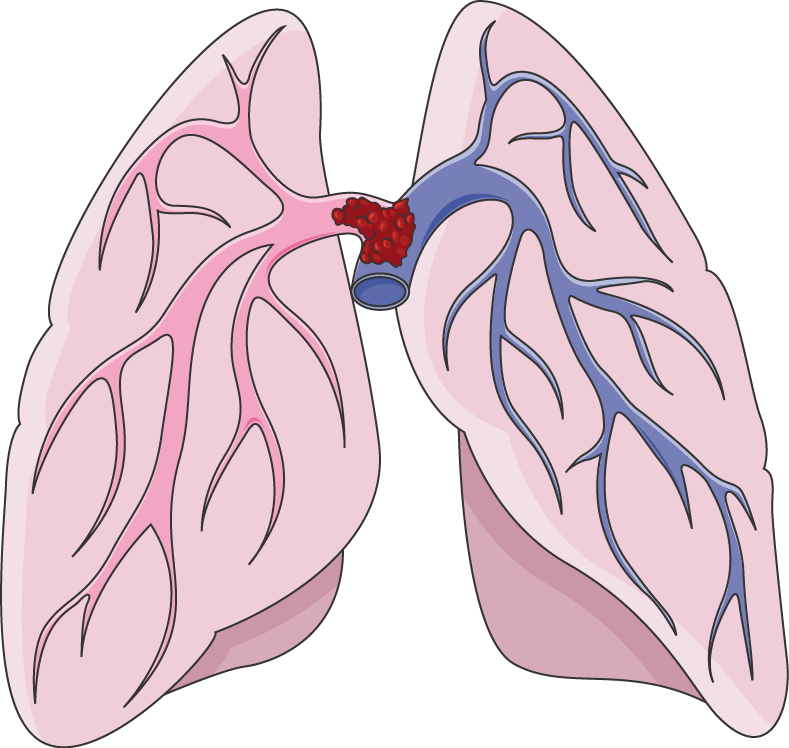 Could a Yellow Bruise Behind the Knee Be a Blood Clot? » Scary Symptoms