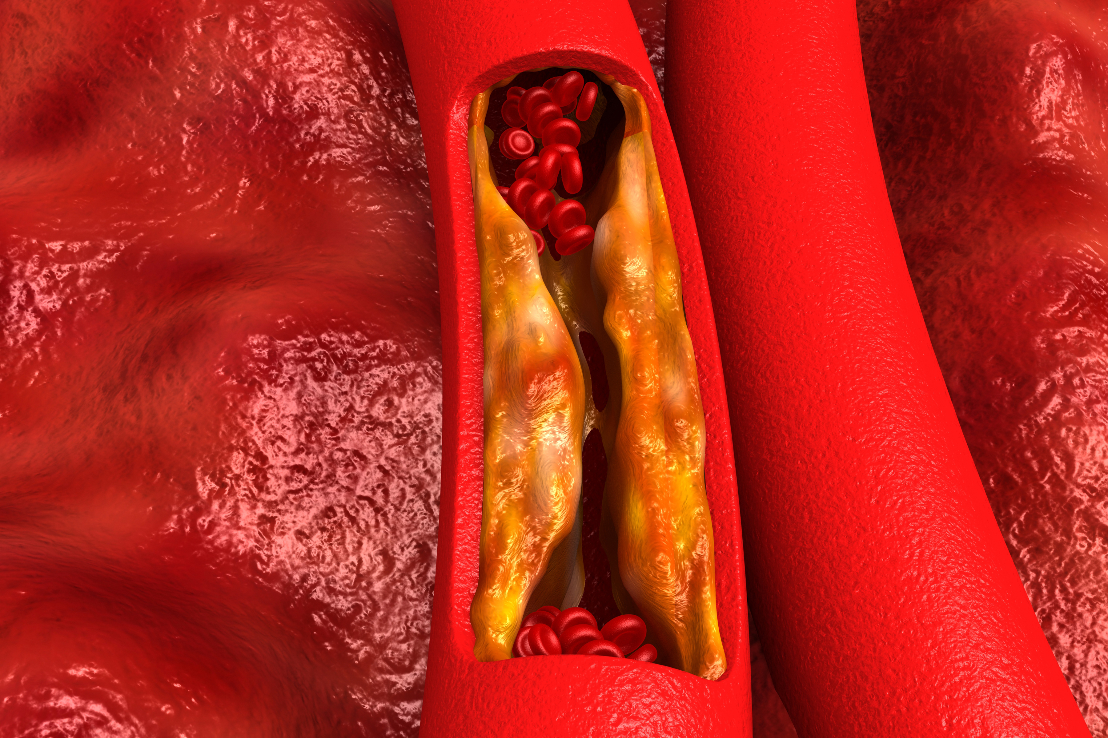 Can Excessive Sitting Clog Your Heart's Arteries?