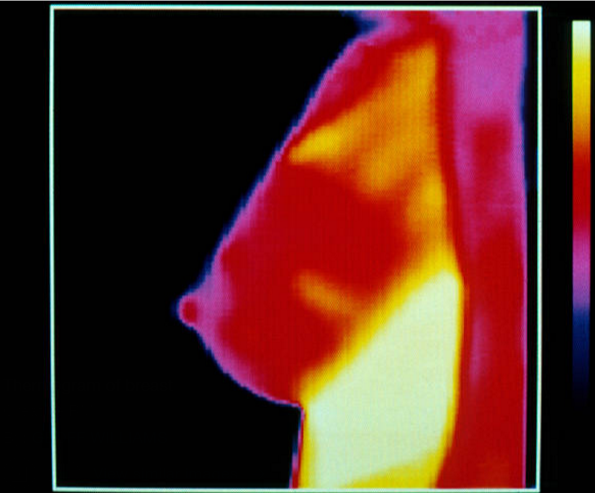 Breast Cancer Thermography: Truth or Hype?