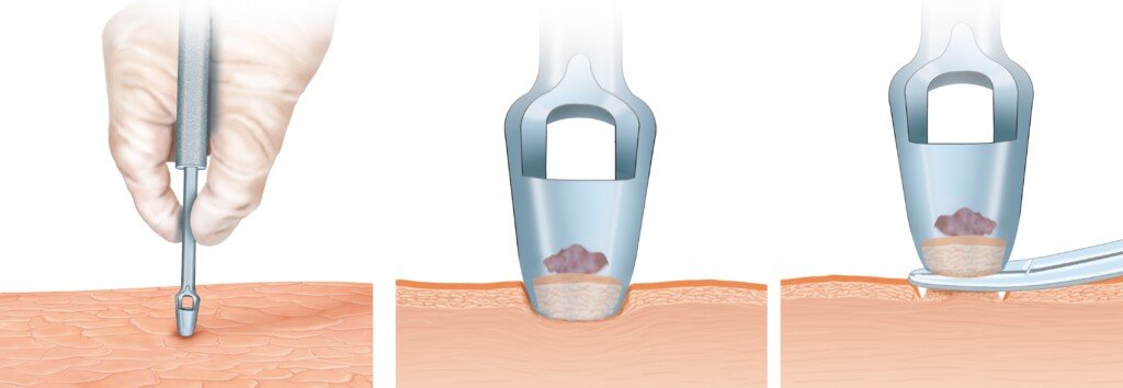 Punch Biopsy for a Mildly Atypical Mole » Scary Symptoms