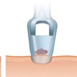 Punch Biopsy for a Mildly Atypical Mole