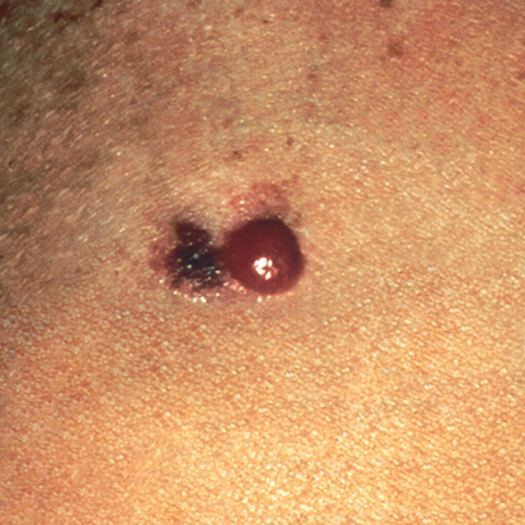 Can You Pick Off Melanoma, How Much & Will it Spread