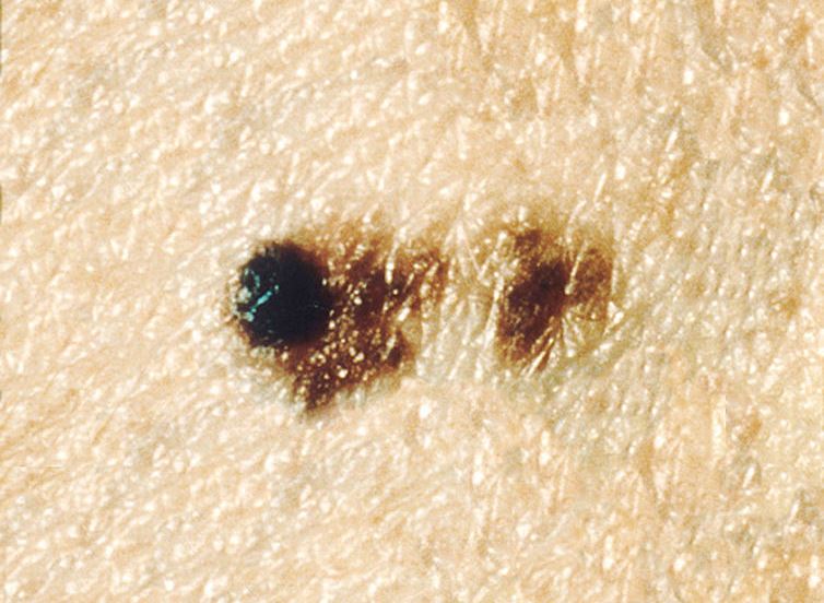 Can You Pick Off Melanoma, How Much & Will it Spread