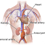 How Often Should a Small Abdominal Aortic Aneurysm Be Followed?