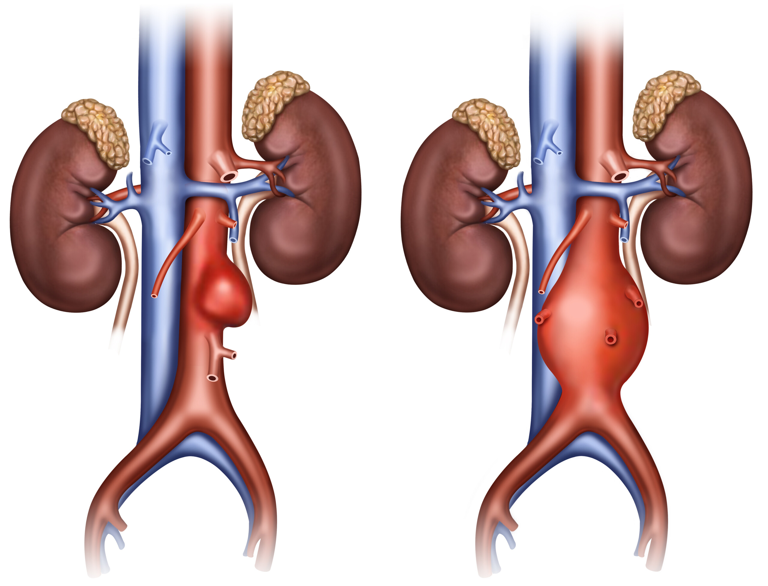 Abdominal Aortic Aneurysm Endovascular Vs Surgical Repair Scary 