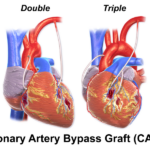8 Medical Staff Errors Following CABG: Personal Account