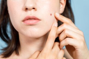 What Does a Tiny Dark Spot in a Mole Mean?