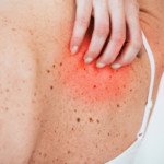 Can You Get Melanoma from Scratching a Mole?