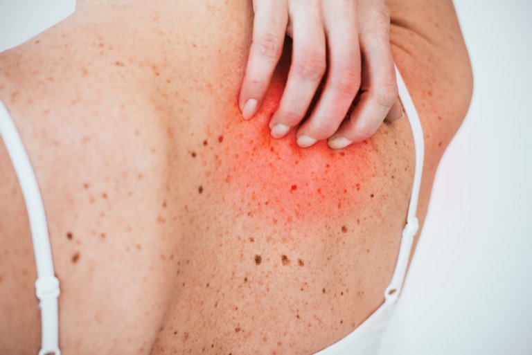 Scratch Mole, It Bleeds: Melanoma? » Scary Symptoms