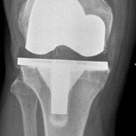 12 Items You’ll Need in the House After Total Knee Replacement