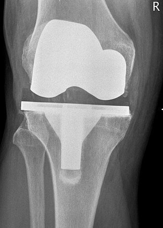 Stem Cell Injection into Total Knee Replacement for Pain Reduction?
