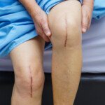 Why Are 2 Knee Replacements at the Same Time Better than One?
