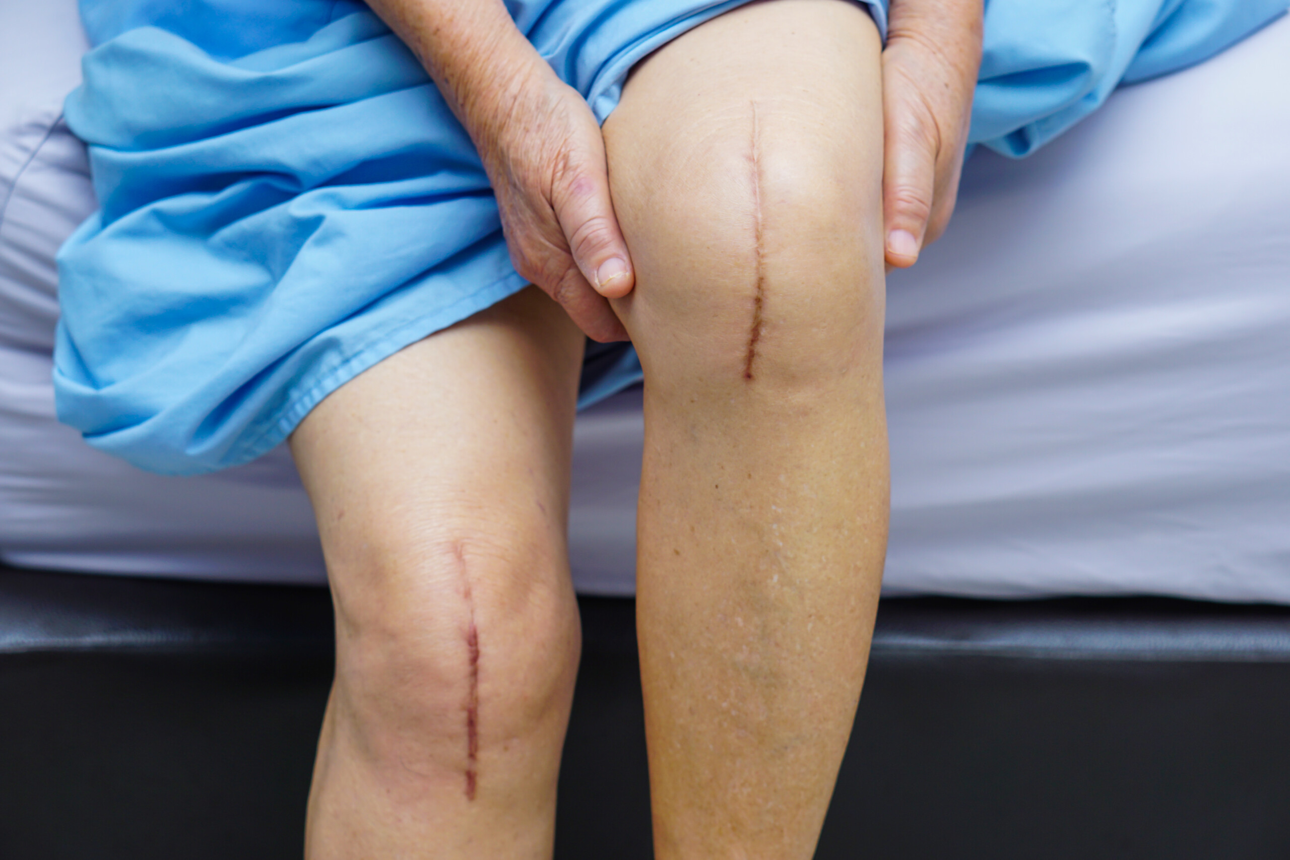 Knee Replacement DVT: Patients at Highest Risk?