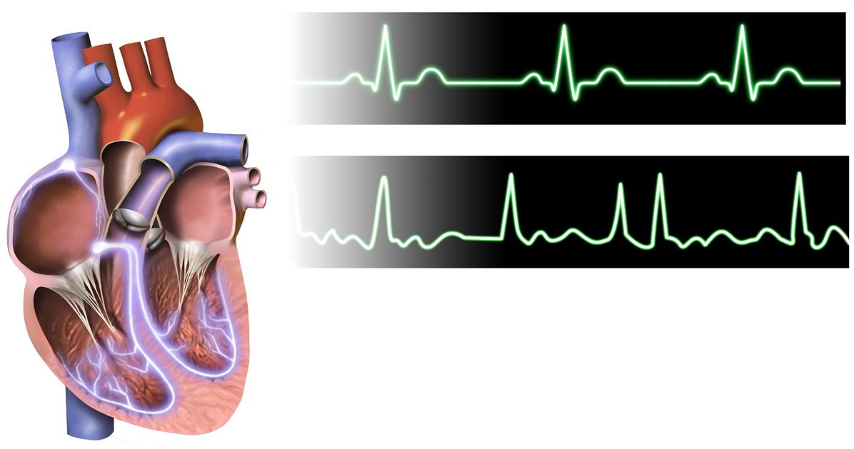 Do Pacemakers Prevent Atrial Fibrillation? » Scary Symptoms