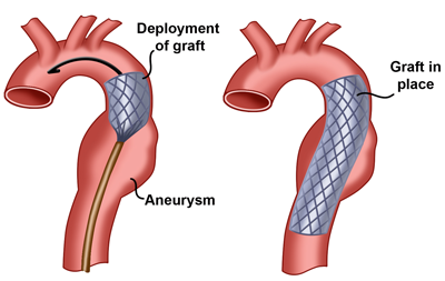 Abdominal Aortic Aneurysm: Endovascular vs. Surgical ... diagram of adhd brain 
