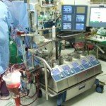 Does the Heart-Lung Machine Affect Sense of Taste?