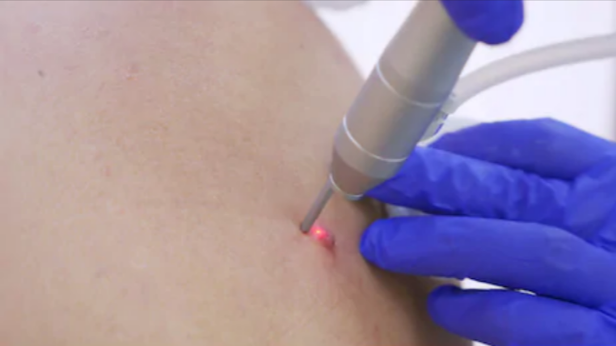 Can Melanoma Be Found After Mole Removal with Laser?