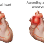 Do Thoracic Aortic Aneurysms Have a Genetic Cause?