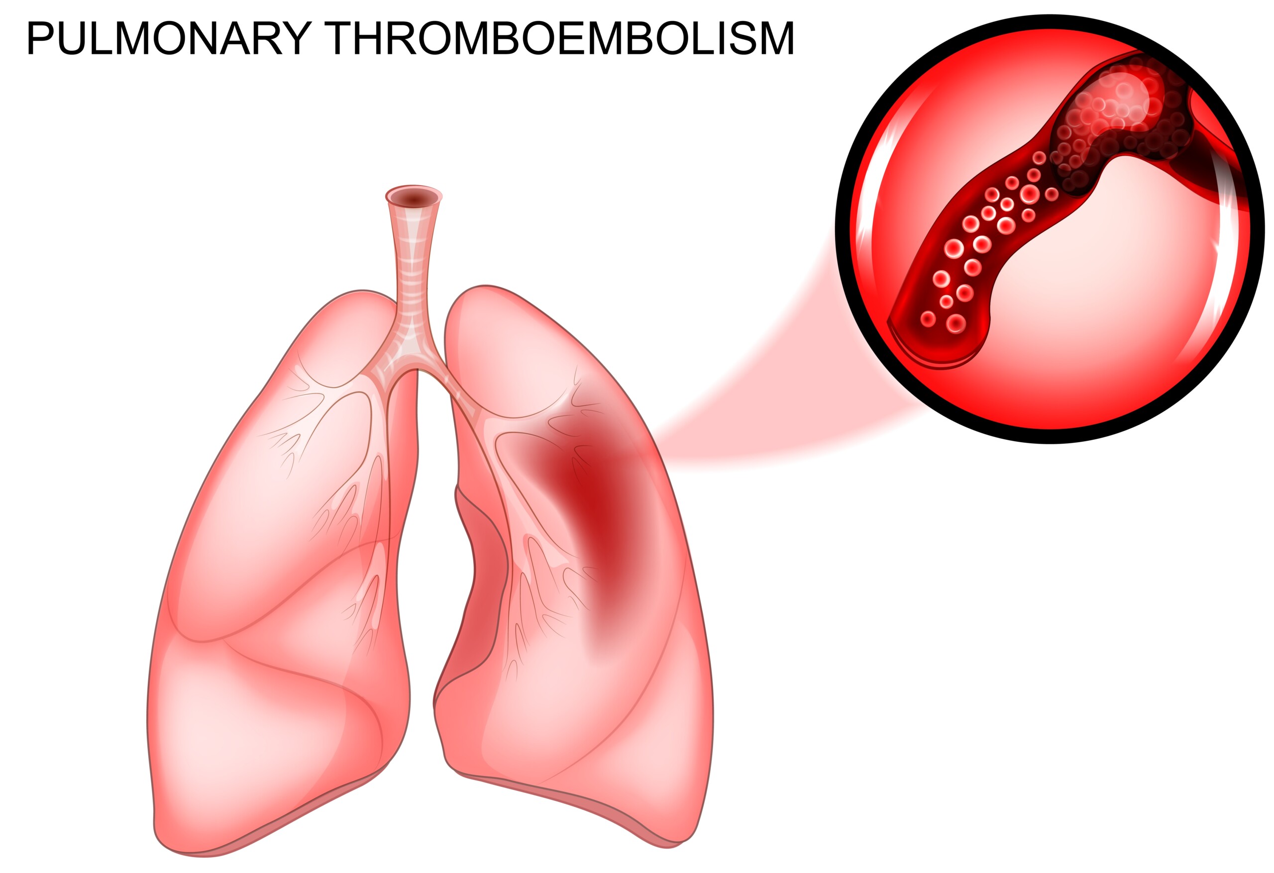 What if You Get a Pulmonary Embolism on a Plane?
