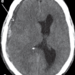 Recurrence of Chronic Subdural Hematoma Missed by Doctor?