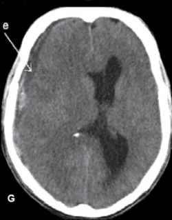 Recurrence of Chronic Subdural Hematoma Missed by Doctor?