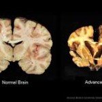 Why Brain Damage in CTE Worsens Decades after Athlete Retires