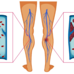 DVT Risk after Joint Replacement Surgery Stays for Years