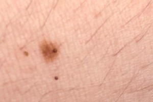 Mole With New Black Specks May Not Be Melanoma Scary Symptoms