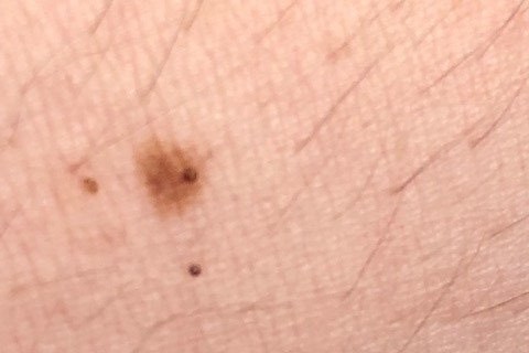 Mole with New Black Specks May Not Be Melanoma