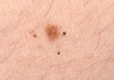 Mole with New Black Specks May Not Be Melanoma » Scary Symptoms