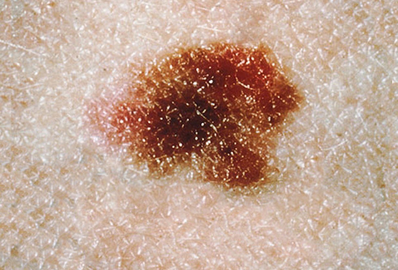 Is Your Mole Larger, More Irregular, Multi-Colored?